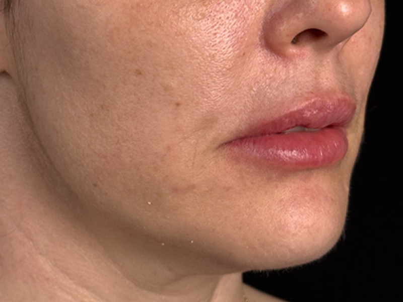 Antes - Contorno mandibular