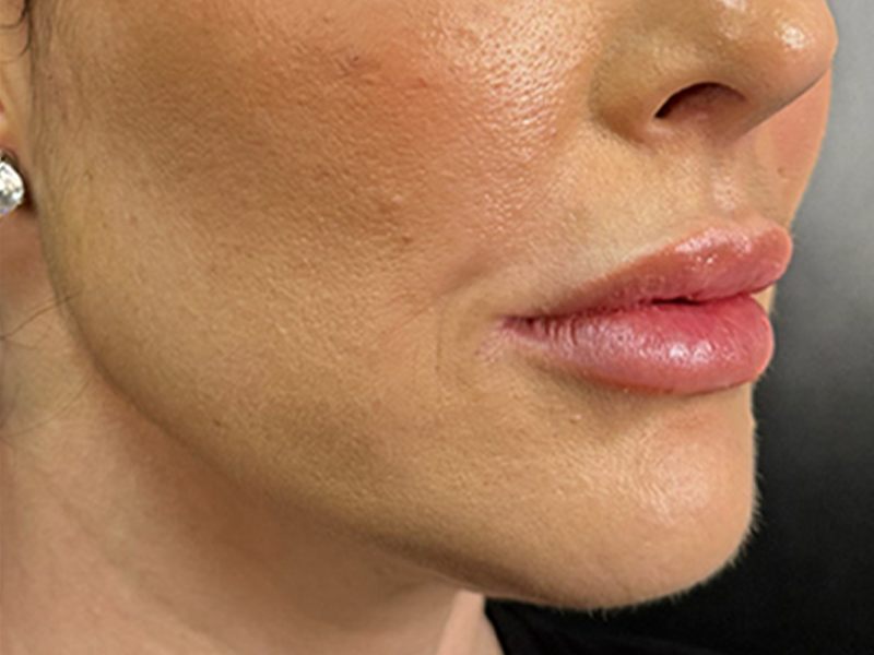 Depois - Contorno mandibular