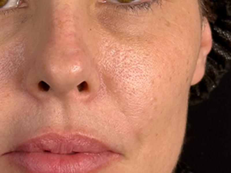 Antes - Região malar