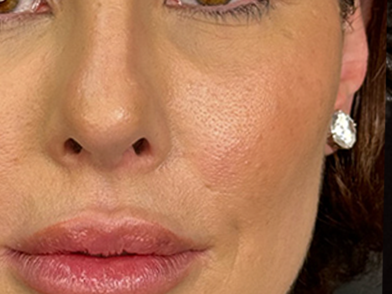 Depois - Região malar