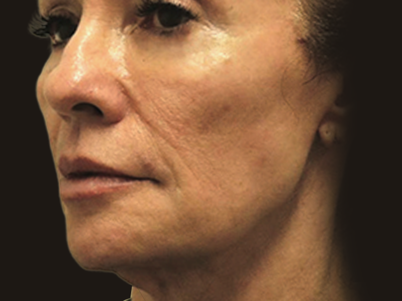 Antes - Terço médio