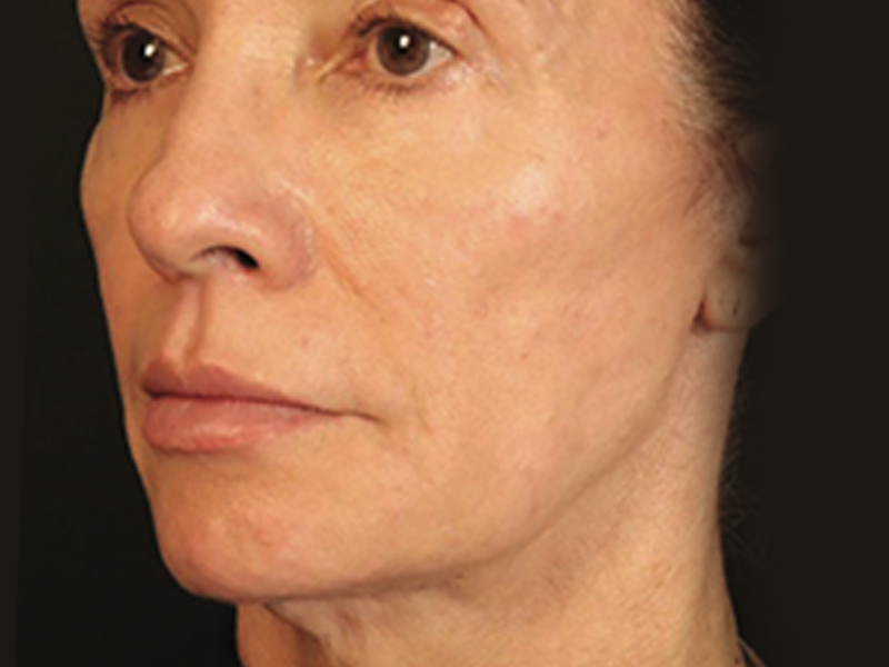 Depois - Terço médio